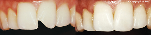Tooth Bonding Tooth Bonding