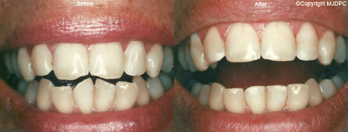 Tooth Contouring Tooth Contouring