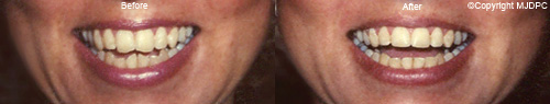 Tooth Contouring Tooth Contouring