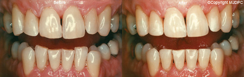 Tooth Contouring Tooth Contouring