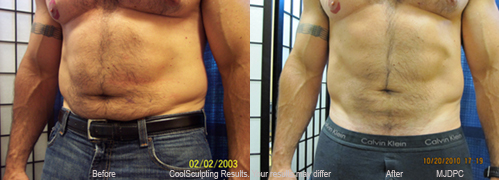 CoolSculpting Results