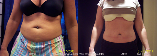 CoolSculpting Results