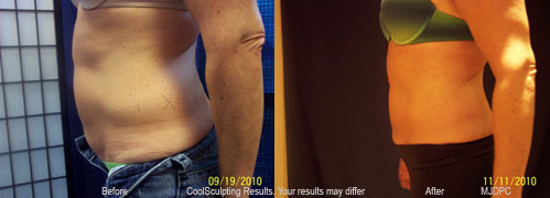 CoolSculpting Results