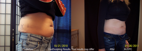 CoolSculpting Results