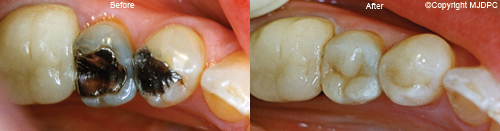 Fillings Fillings