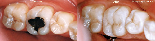 Fillings Fillings