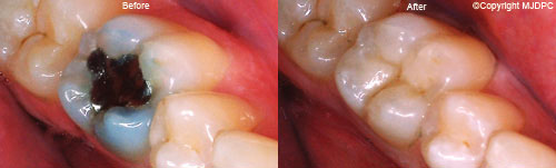 Fillings Fillings