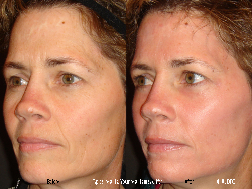 CO2 Laser Resurfacing & Patient Results 