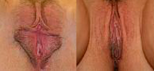 Labiaplast Before and After Photos