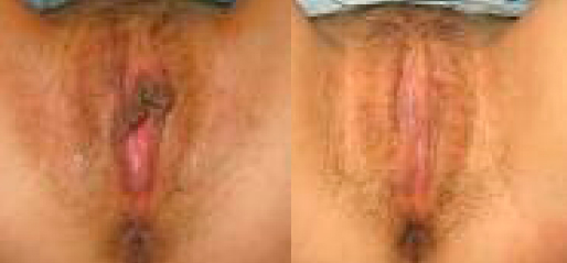Labiaplast Before and After Photos
