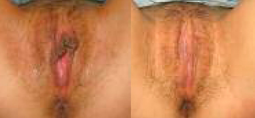 Labiaplast Before and After Photos Labiaplast Before and After Photos