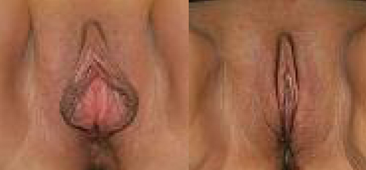 Labiaplasty Before and After Photos
