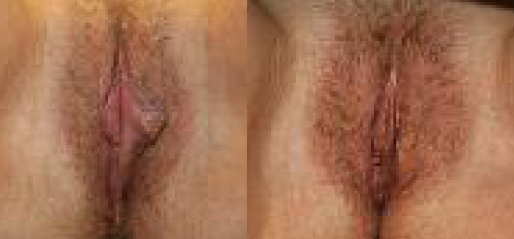  Labiaplasty Before and After Photos