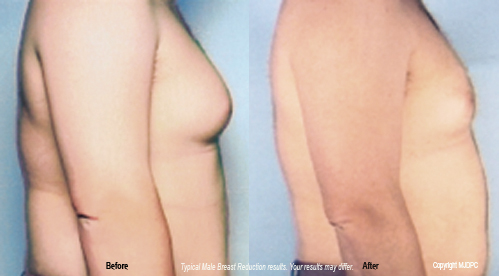 breast reduction recovery. Is male reast reduction