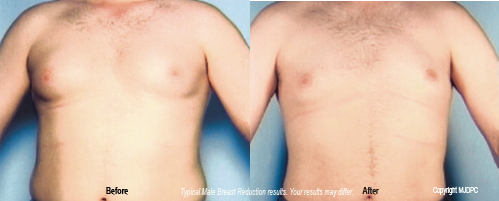 Male Breast Reduction