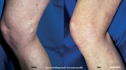 Why Is It Important to Treat Your Varicose Veins? - Vein Specialists of the  Carolinas