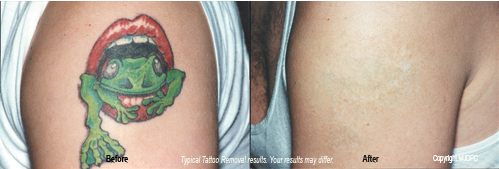 how are tattoos removed tattoo removal is performed by dr
