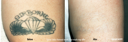 Tattoo Removal, Marie DiLauro MD - Reflections. Columbus - Worthington ...