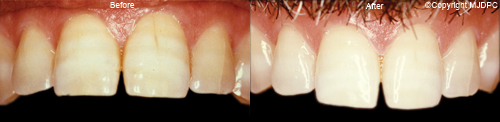Tooth Whitening Tooth Whitening